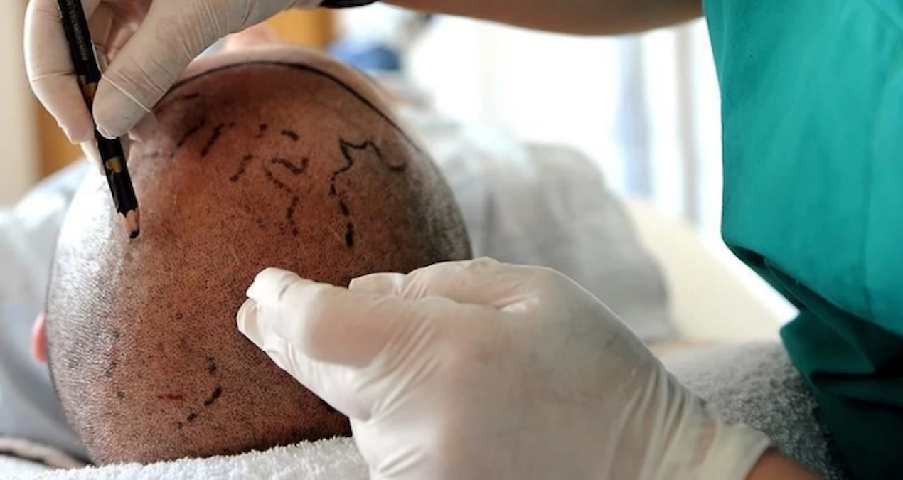 Saç ekim uzmanı bakın kim çıktı! Milli futbolcumuza bile saç ekmiş, şimdi hapse girecek